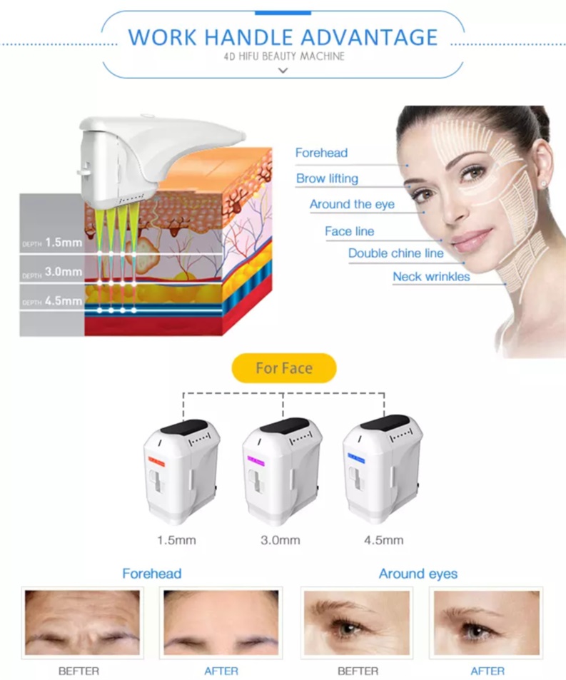 Hifu Facelift Machine