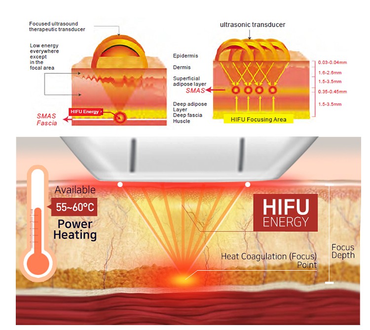 2D HIFU for face body