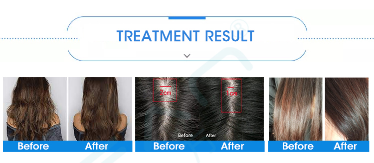 Scalp Treatment Machine
