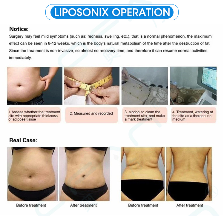 Liposonix