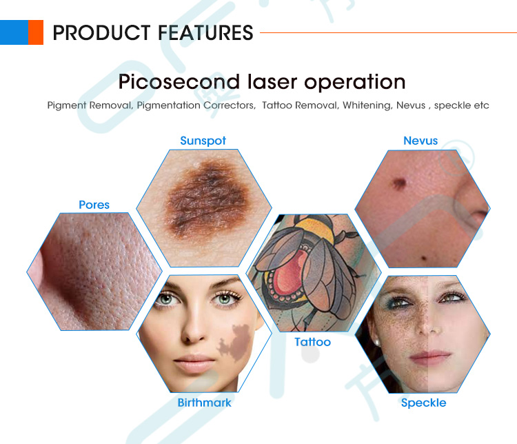Factory Price Pico Picosecond Laser Machine Handle For Tattoos Pigmentation Remove