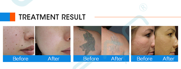 Picosecond Portable Laser Blemish Acne and Tattoo Removal