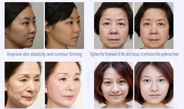 Is HIFU Face Lift Machine Effective