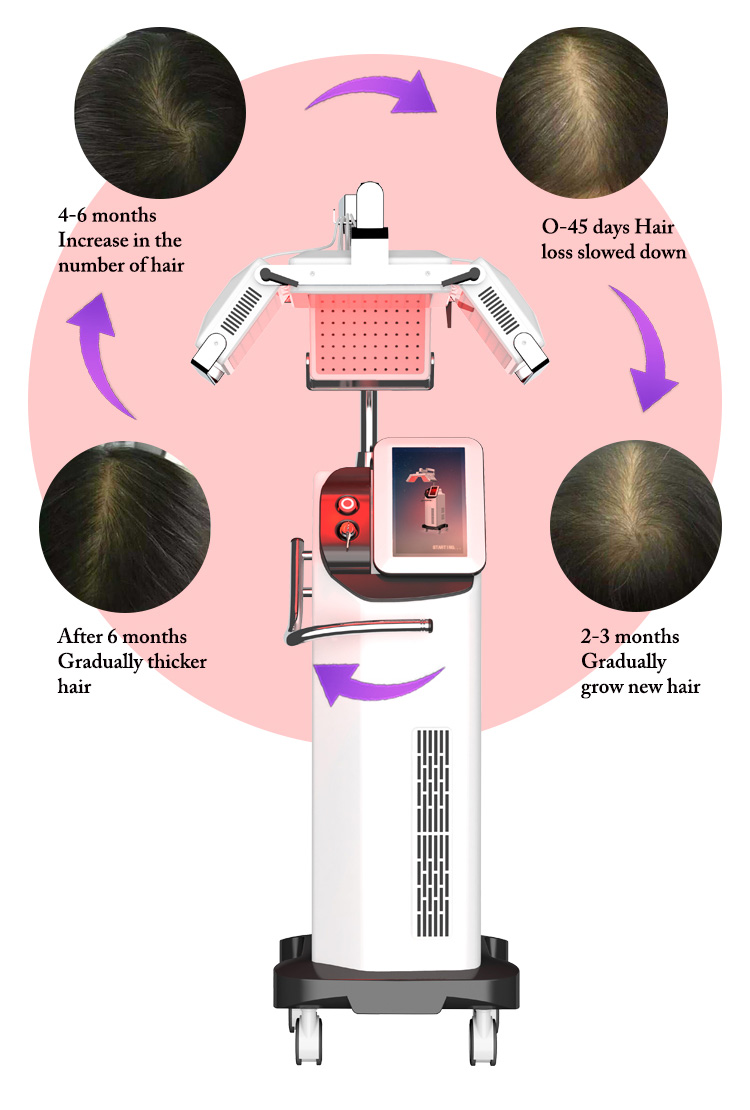 Red Led Light 660NM Diodo Laser hair regrowth hair loss machine