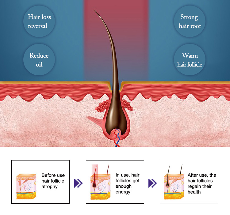 Red Led Light 660NM Diodo Laser hair regrowth hair loss machine