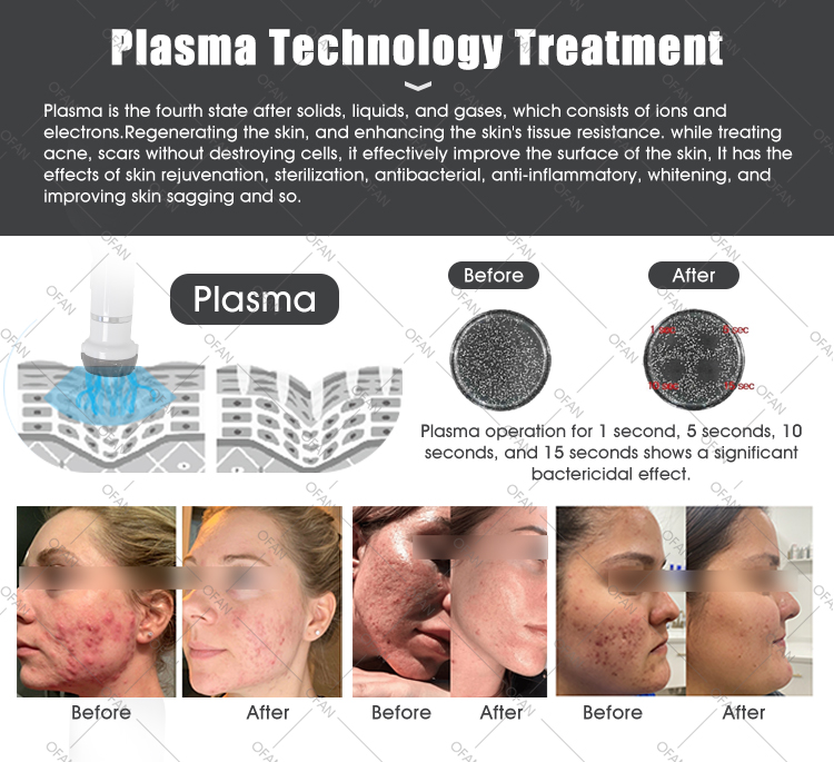 Portable anti-inflammatory and acne removal skin care plasma beauty equipment