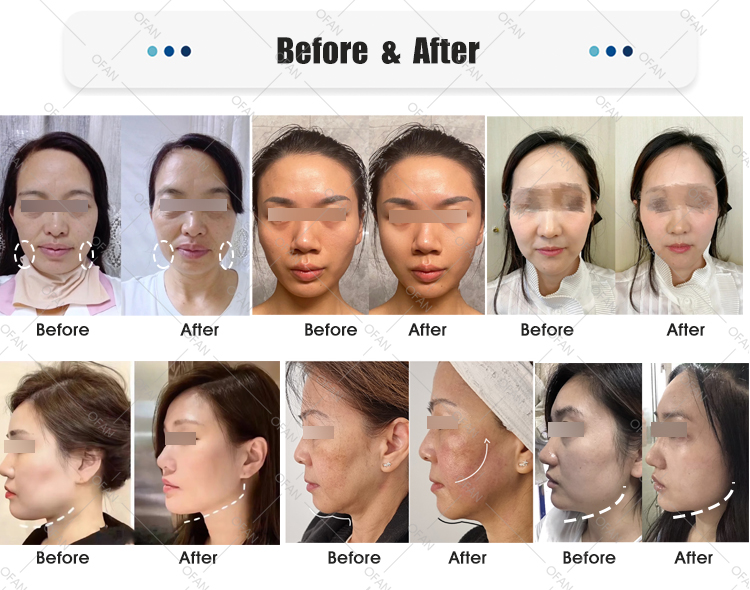 OFAN aesthetics high intensity Electromagnetic muscle Sculpting HIFE Ems Face facial toning emface