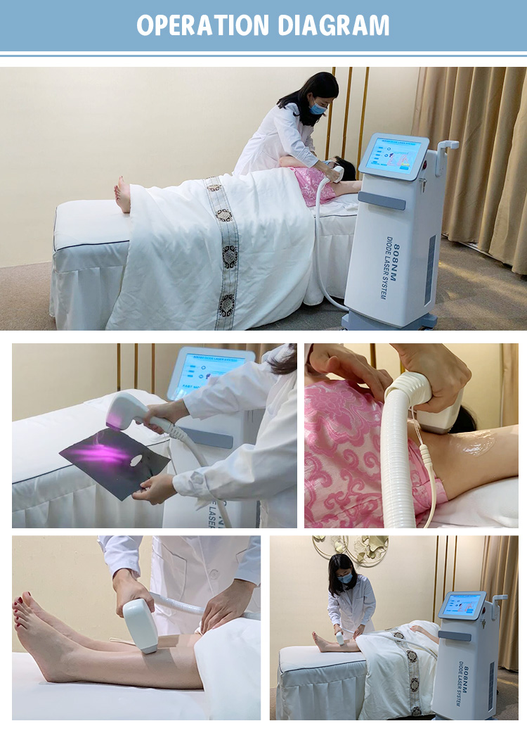 OFAN belleza laser beauty equipment 808/755/1064nm diode laser hair removal