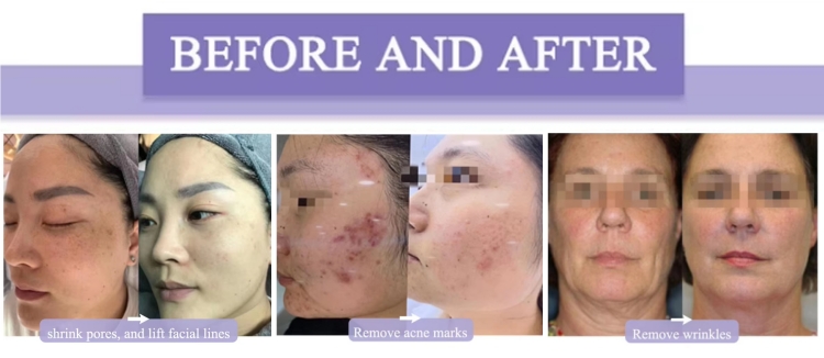 OFAN 3 in 1 Wrinkle Removal Skin Tightening High Intensity Focused Ultrasound Hifu Machine
