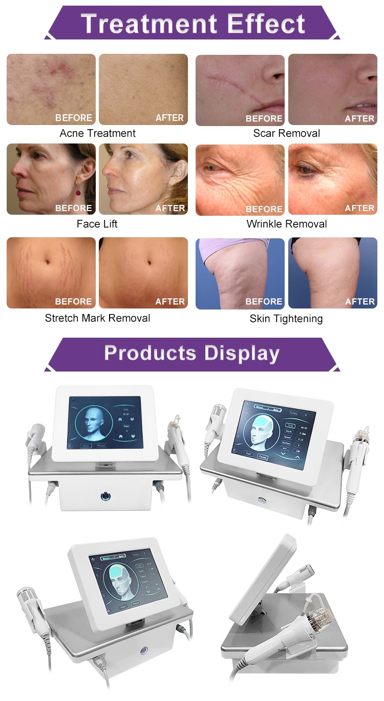 OFAN RF Fractional Microneedling Machine